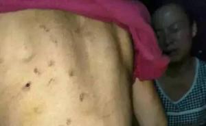 安徽一8歲女童遭生母虐待渾身傷痕，警方：其母被行拘8日