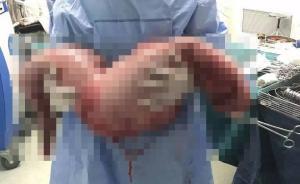 22岁男子从小便秘靠开塞露“续命”，手术切13公斤巨结肠