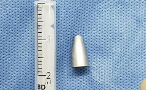 8歲男孩吞下筆頭后咳嗽發(fā)燒一個(gè)月，來滬順利手術(shù)轉(zhuǎn)危為安