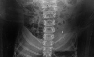 6歲女孩補牙時工具針誤吞進肚，所幸住院三天后自然排出體外