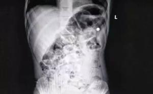 7歲男孩被仿真氣槍射中，鋼珠子彈離心臟只有兩三厘米