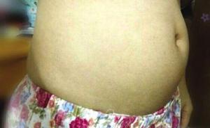 廣州26歲女子賣卵子賺1萬(wàn)2，頻繁打促排卵針產(chǎn)生腹水