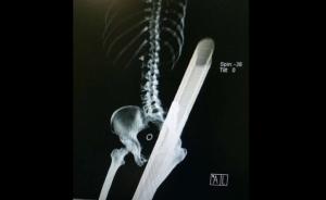 珠海女司机撞飞护栏,下半身被钢管贯穿