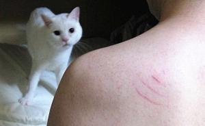 释新闻｜打了狂犬疫苗为啥还发病？何种情况要打免疫球蛋白？