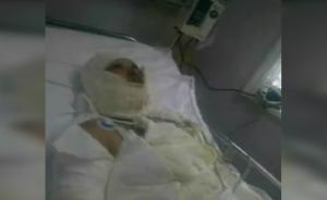 兄妹吵架哥哥自焚，妻子撲救被燒重傷