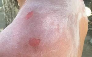 暖聞｜湖北一交警被曬傷脫警服時撕下4塊皮膚，一天后又上崗