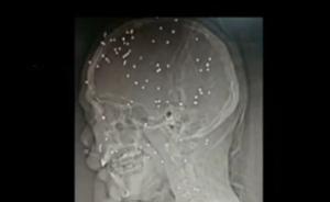 廣東一男子被蒙面暴徒持霰彈槍射擊，頭部殘留80顆鋼珠