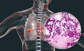 肺癌患者是新冠病毒感染高危人群，如何防護？