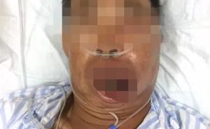 嘉興一男子擠破上嘴唇一顆“痘”，醫(yī)生連下兩張病危通知書