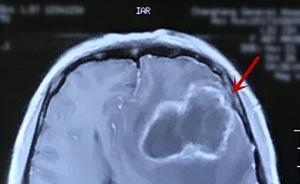 湖北一女子收养流浪猫狗意外感染细菌，引起脑脓肿