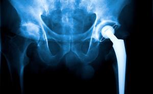 人造髖關(guān)節(jié)缺陷致6名患者切除臀部，強(qiáng)生被判賠2.5億美元