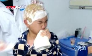 爸爸严重烧伤,13岁男孩两取头皮救父