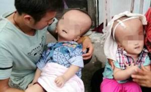 “大頭”雙胞胎兄弟來滬治療，受助后治療費仍缺弟弟尚未手術