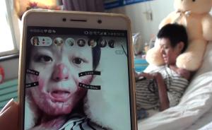 17岁青岛烧伤女孩:玩直播,笑对生活