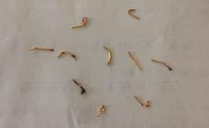 男子被泰国“大师”植入12条护身符，七年后感不适手术取出