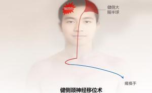 華山醫(yī)院團隊：神經受損上肢癱瘓，“換個大腦”有望恢復功能