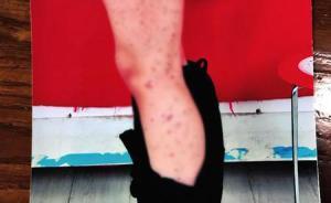 陕西一女生被同桌用笔扎得满腿是伤，校方称是同学间开玩笑