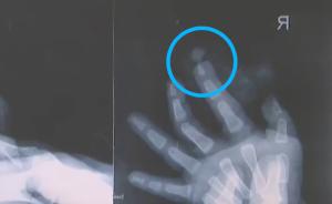 女婴手指被夹断，婴儿车斗篷是祸首