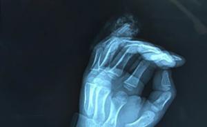 7歲男童玩校服褲腰帶小指被整節(jié)扯斷，醫(yī)生提醒注意各類繩線