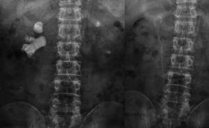 四川男子腎結(jié)石30年反復(fù)碎石再瘋長，醫(yī)生：或因長期飲濃茶