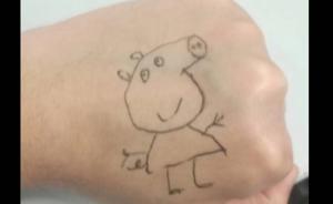 兒科醫(yī)生手背畫“小豬佩奇”：患兒開心