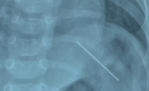 4月大婴儿腹腔扎入一根针：新衣上残留