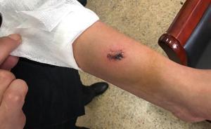 南京一醫(yī)院保安抱住輕生患者被咬下一塊肉：只想著不能松手