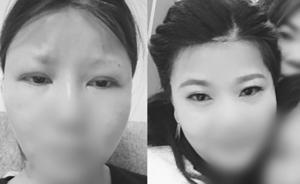 割雙眼皮割成“熊貓眼”一年后能嚇哭孩子，院方退賠1.5萬