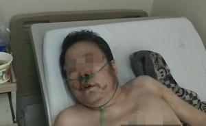 住院吸氧時抽煙致爆炸，男子燒傷自己臉