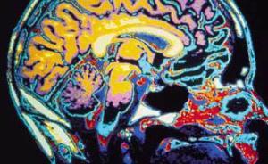 中科院探索重度抑郁癥治療新思路：腦成像定量預(yù)測治療效果