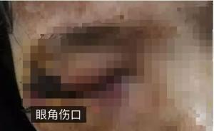 寧波女子被撞要拔4顆門牙，肇事外賣員：沒錢，要賠償找公司