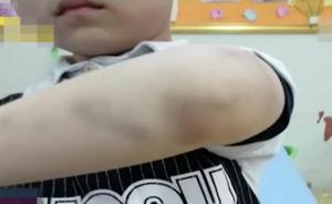 男童长期受伤学校报警，其父：多管闲事