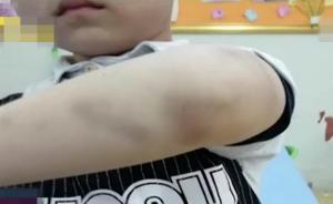 男童长期受伤学校报警，其父：多管闲事