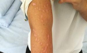 陜西渭南一女子深夜回家進(jìn)入施工路段，施工車突噴瀝青致燒傷