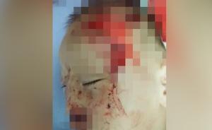 1歲半女童遭狗撲倒撕咬,額頭被咬出洞