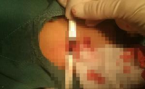 大連3天連發(fā)兩起大型犬傷童事件：一9歲男童氣管被咬穿