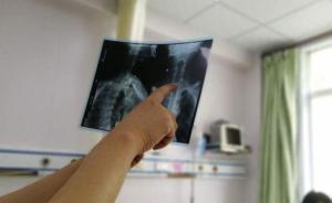 六旬老漢吃粽子時(shí)聽朋友笑話，忍不住發(fā)笑棗核滑入卡住食道