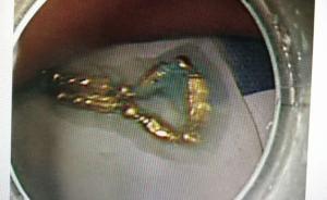 寧波女子與丈夫吵架后“吞金自殺”，胃鏡取出10厘米金項鏈