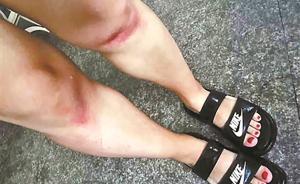 護士為溺水者做心肺復(fù)蘇跪腫膝蓋，朋友圈曬“不美腿照”獲贊